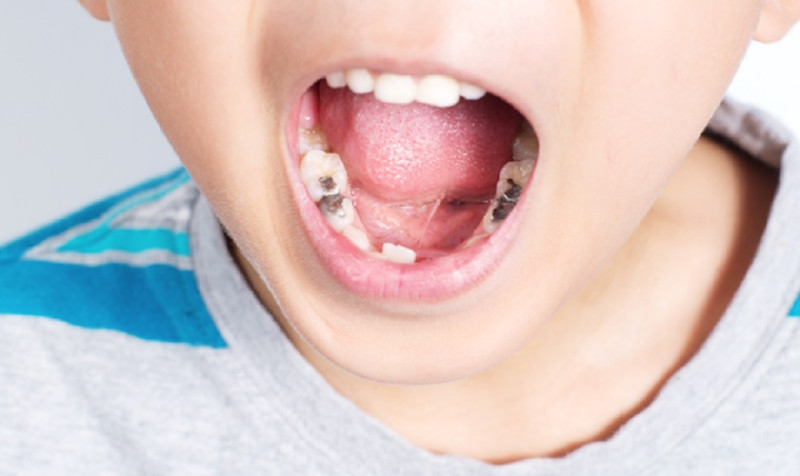Trẻ 3 tuổi bị sâu răng hàm - Giải pháp nào là tốt nhất giúp bảo vệ nụ cười cho trẻ